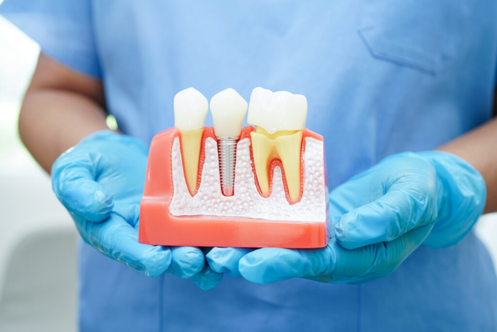 How Dental Implants Help Prevent Jawbone Loss—and Why It Matters
