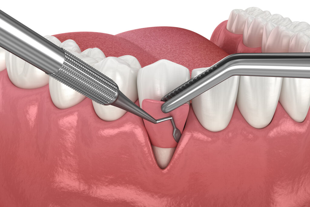 How to Tell If You Need Gum Grafting: Signs You Shouldn’t Ignore